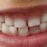 Prima visita dall'Ortodontista bisogna aspettare che cadano tutti i denti?